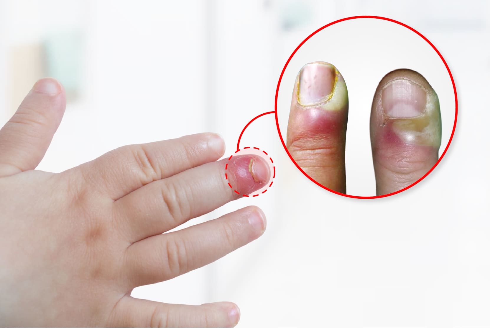 Nail Infections